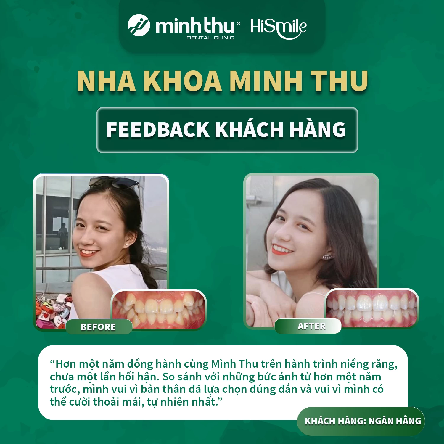 NIỀNG RĂNG INVISALIGN TẠI NHA KHOA MINH THU: HÀNH TRÌNH THAY ĐỔI NỤ CƯỜI TỪ KHÁCH HÀNG TRẦN NGÂN HẰNG