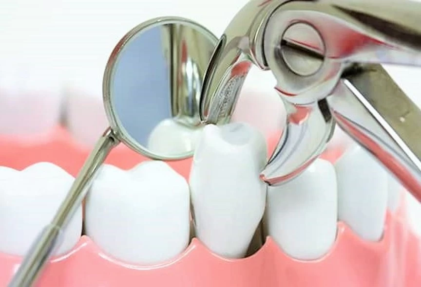 NHỔ RĂNG TRƯỚC KHI NIỀNG CÓ NGUY HIỂM KHÔNG? – CHUYÊN GIA HISMILE GIẢI ĐÁP