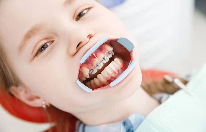 NIỀNG RĂNG SỚM CHO TRẺ BỊ THỞ MIỆNG: 3 DẤU HIỆU CHA MẸ KHÔNG NÊN BỎ QUA