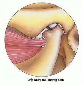 VIÊM KHỚP THÁI DƯƠNG HÀM: NGUYÊN NHÂN, DẤU HIỆU & CÁCH TRỊ