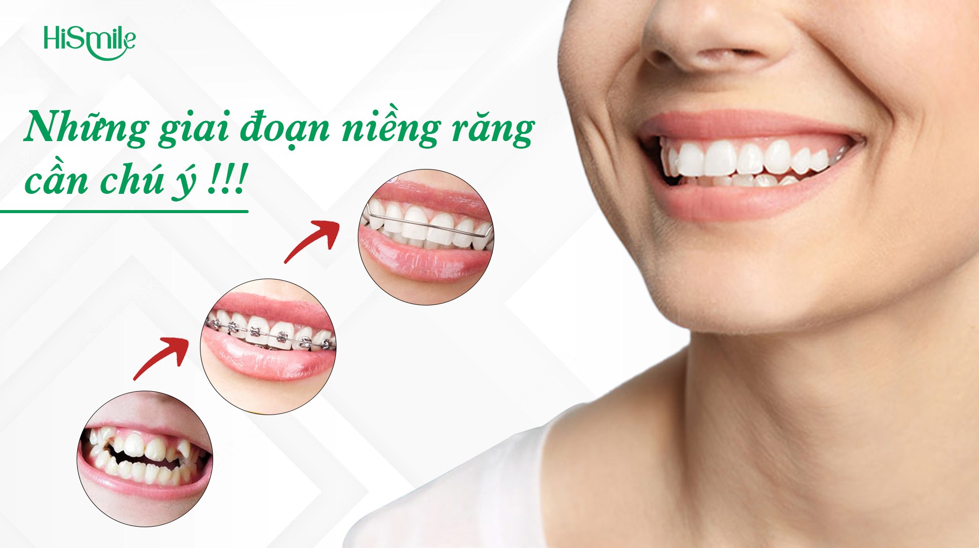 6 GIAI ĐOẠN QUAN TRỌNG TRONG QUÁ TRÌNH NIỀNG RĂNG