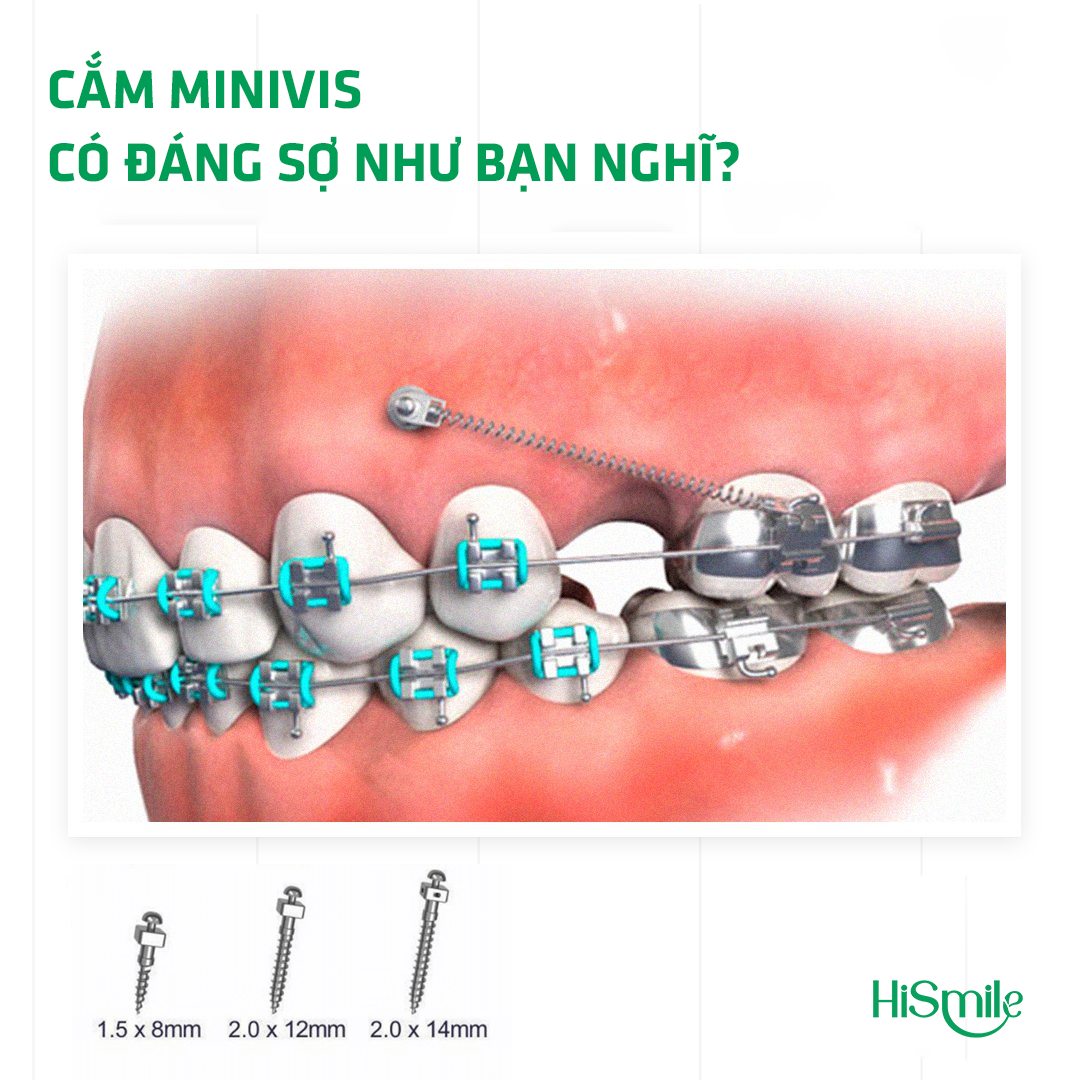 CẮM MINIVIS TRONG NIỀNG RĂNG: KHÔNG ĐÁNG SỢ NHƯ NHIỀU NGƯỜI VẪN NGHĨ