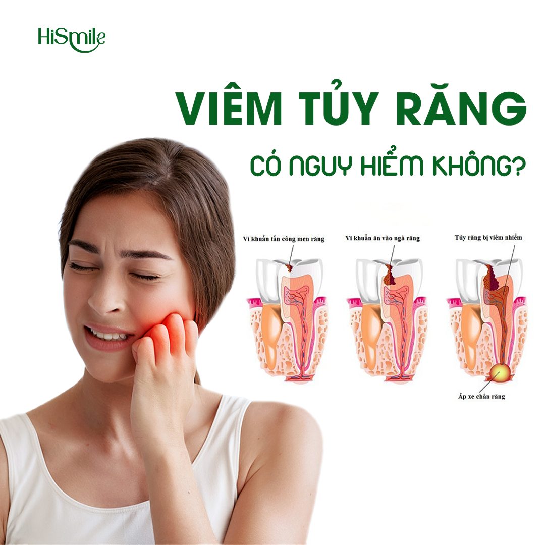 VIÊM TỦY RĂNG CÓ NGUY HIỂM KHÔNG? NHỮNG ĐIỀU CẦN BIẾT ĐỂ TRÁNH BIẾN CHỨNG