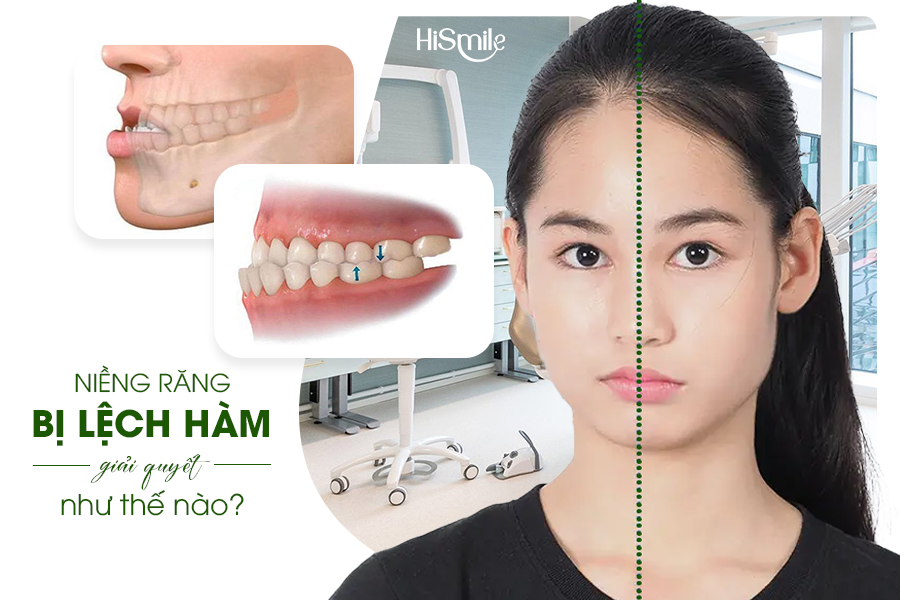 NIỀNG RĂNG BỊ LỆCH HÀM: NGUYÊN NHÂN VÀ HƯỚNG XỬ LÝ